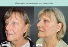 Cas n°4 résultat lifting cervico-facial et blépharoplastie à 6 mois de face trois-quarts gauche