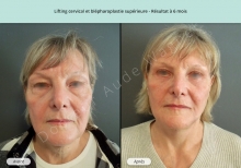 Cas n°4 résultat lifting cervico-facial et blépharoplastie à 6 mois de face