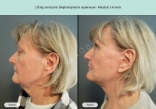 Cas n°4 résultat lifting cervico-facial et blépharoplastie à 6 mois de profil gauche