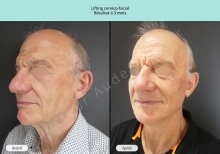 Cas n°8 résultat av ap de lifting cervico-facial à Toulouse