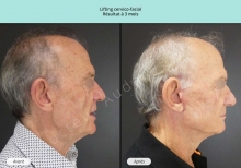 Cas n°8 résultat avant après de lifting cervico-facial ou chirurgie du visage et du cou à Toulouse