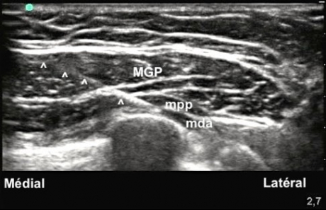 Echographie chirurgie esthétique sein