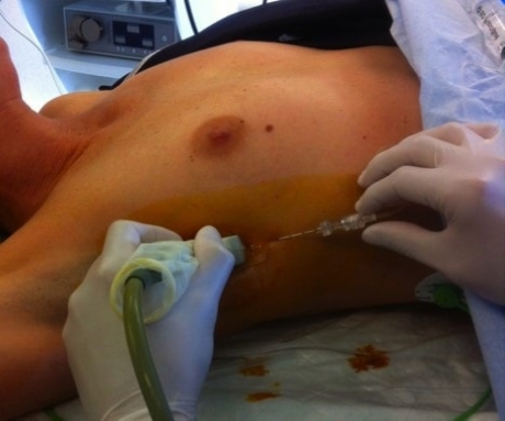 Infiltration de l’analgésie sous échographie chez une patiente endormie juste avant la chirurgie